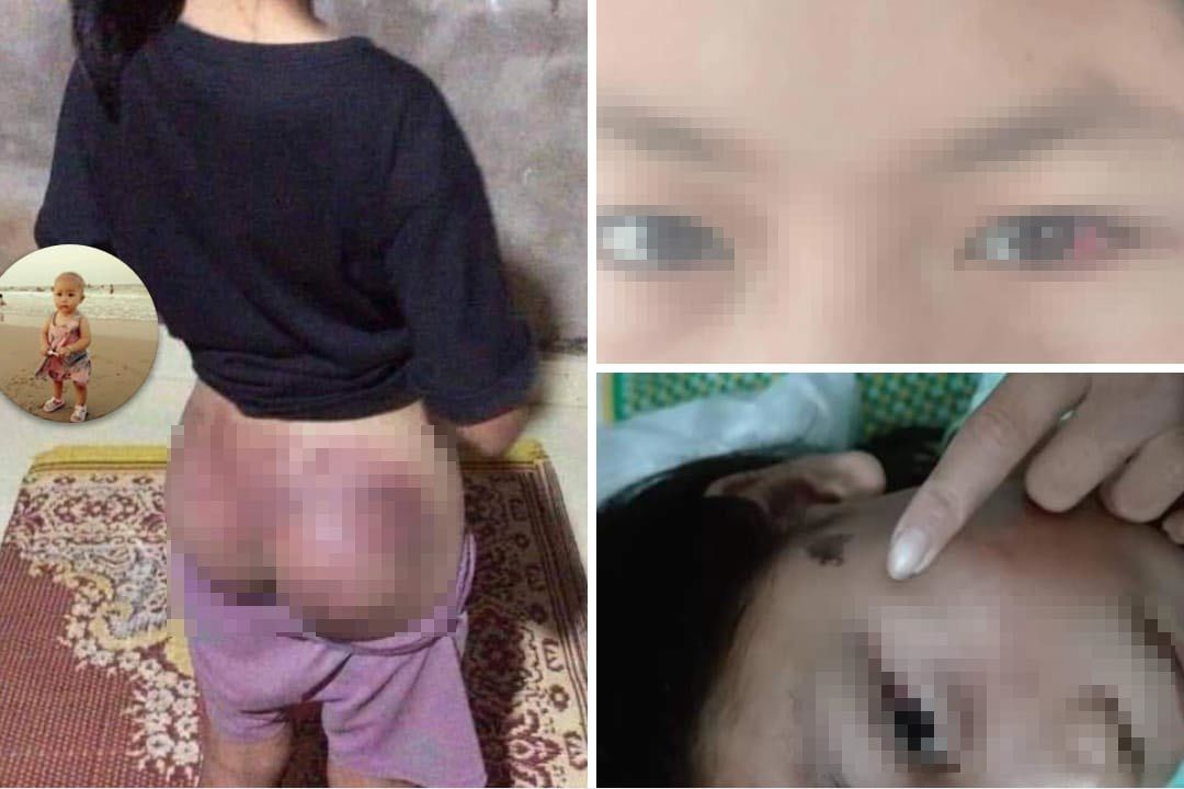 Nghi trộm tiền, bé gái ở Hà Tĩnh bị công an viên đánh bầm tím-1