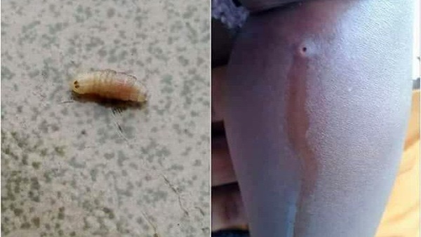 2 sinh vật lạ làm tổ trên đầu người phụ nữ - câu chuyện cảnh báo mọi người cần cẩn trọng trong những chuyến du lịch-2
