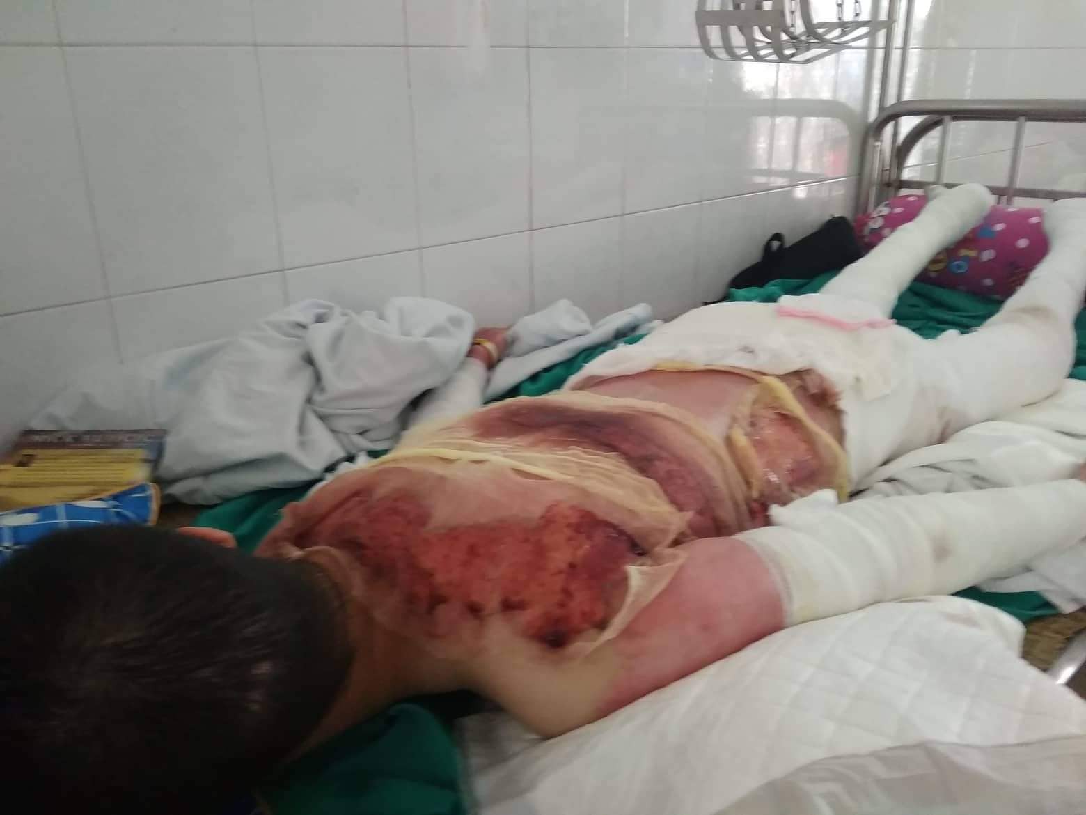 Nỗi đau của người vợ bị chồng tẩm xăng thiêu sống, bỏng 79% cơ thể: Hi sinh tất cả vì 1 người đàn ông rồi cuối cùng suýt mất cả mạng-3