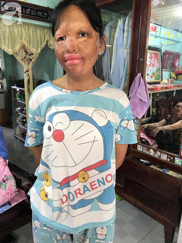 Bé gái biến dạng khuôn mặt, mất một bên tai và ước mơ nhói lòng: Em muốn làm họa sĩ để vẽ mình đẹp hơn-2