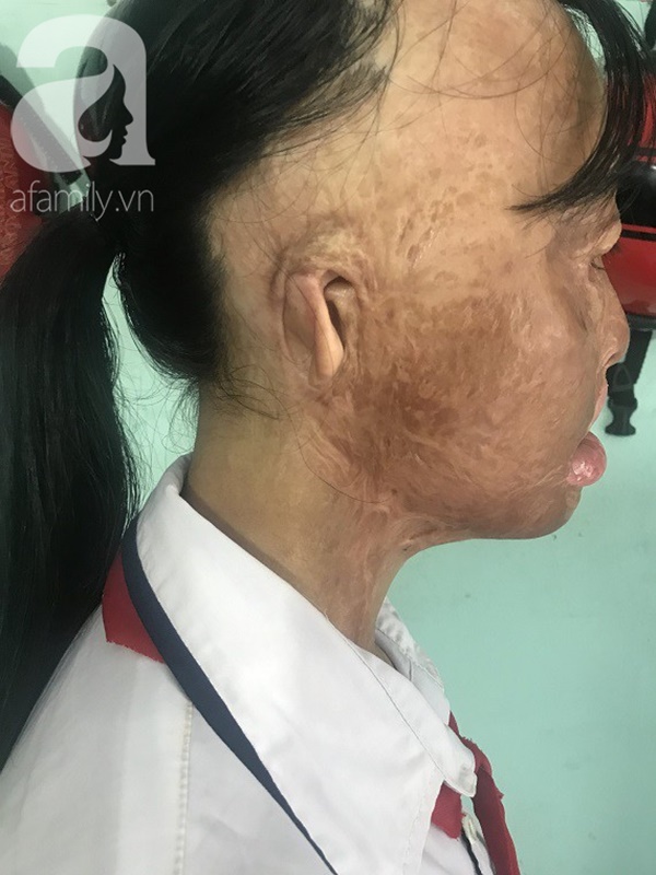 Bé gái biến dạng khuôn mặt, mất một bên tai và ước mơ nhói lòng: Em muốn làm họa sĩ để vẽ mình đẹp hơn-5