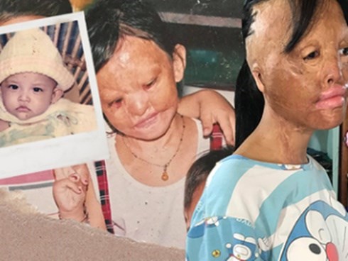 Bé gái biến dạng khuôn mặt, mất một bên tai và ước mơ nhói lòng: 