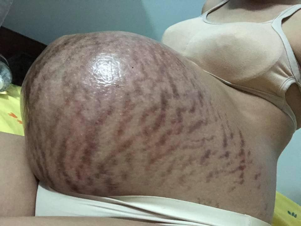 Hình ảnh chiếc bụng của mẹ trước và sau sinh gây bão nhất ngày 1/6: Để có những đứa con chào đời, cái giá của mẹ là đây-1