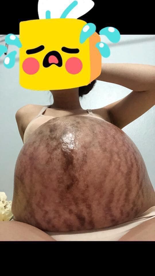 Hình ảnh chiếc bụng của mẹ trước và sau sinh gây bão nhất ngày 1/6: Để có những đứa con chào đời, cái giá của mẹ là đây-2