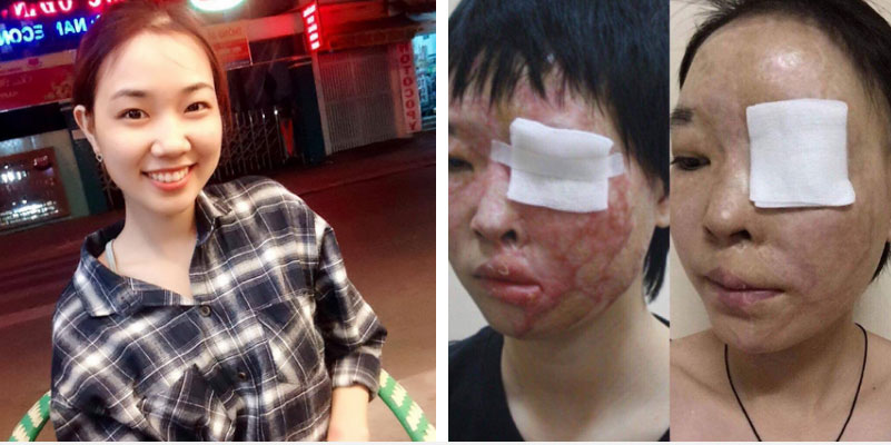 Ngôn tình dành cho cô gái bị tạt axit nhầm biến dạng khuôn mặt: Tình yêu đến vào lúc cuộc đời tăm tối, bế tắc nhất-1