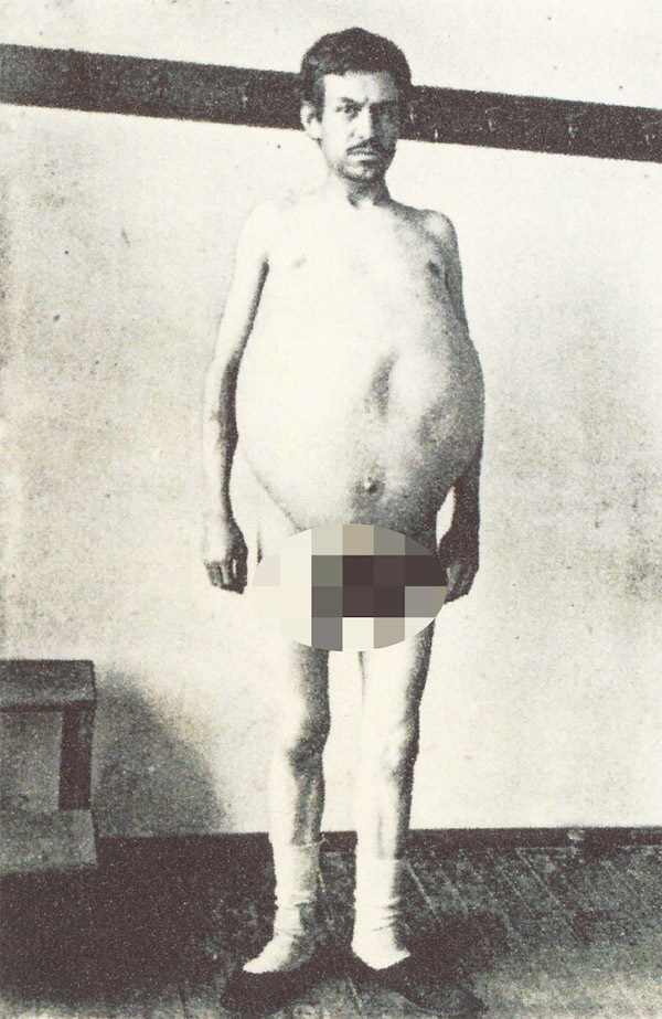 Người đàn ông chết khi đang đi vệ sinh, ruột được giữ ở bảo tàng mãi mãi-2