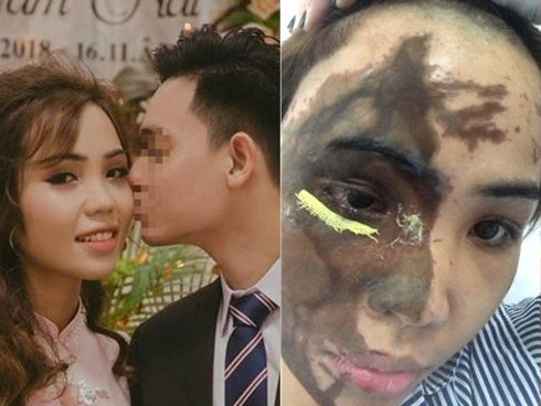 Vụ công an tạt axit vợ sắp cưới: Tại sao giám định thương tích hai lần khác nhau?-3