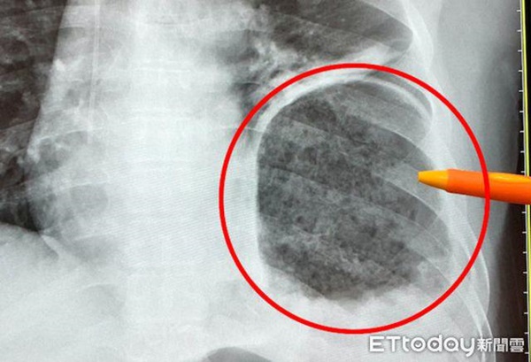 Dạ dày người đàn ông chạy lên phổi, vỡ cơ hoành do làm điều này khi đi vệ sinh-1