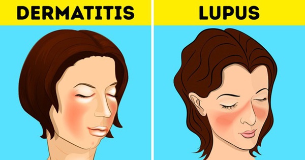 6 căn bệnh thường bị nhầm lẫn với bệnh khác: Chậm trễ điều trị có thể gây nguy hiểm-6