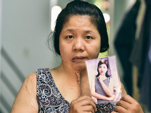 Nỗi ám ảnh kinh hoàng của những nạn nhân hứng đòn trả thù tàn độc bằng axit của kẻ cuồng ghen-4