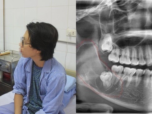 Thanh niên Hà Nội tưởng mọc răng khôn, bác sĩ lôi ra ‘thủ phạm’ trong miệng