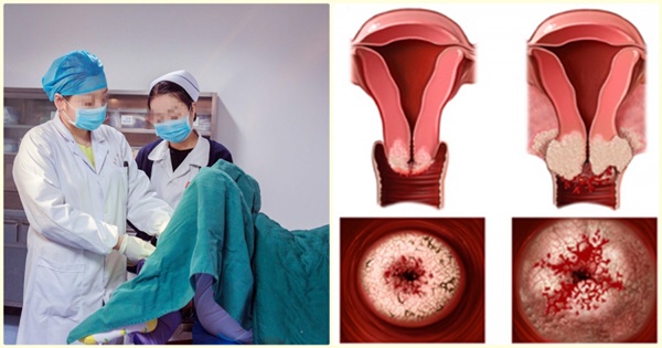 3 việc phụ nữ thường quen làm khiến tử cung bị bào mòn, viêm nhiễm nặng: Bỏ ngay trước khi quá muộn-1