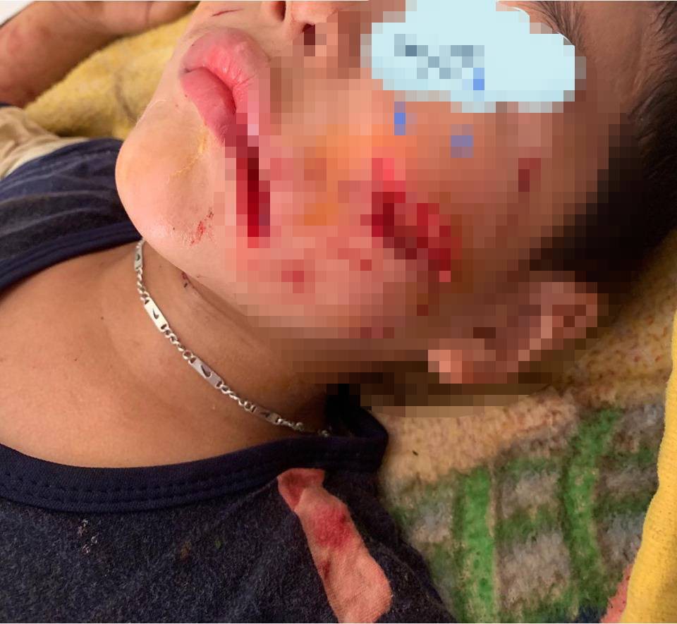 Kinh hoàng bé trai 6 tuổi bị chó nhà nuôi cắn nát mặt và đỉnh đầu-1