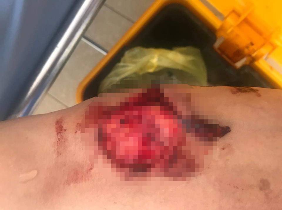 Kinh hoàng bé trai 6 tuổi bị chó nhà nuôi cắn nát mặt và đỉnh đầu-2