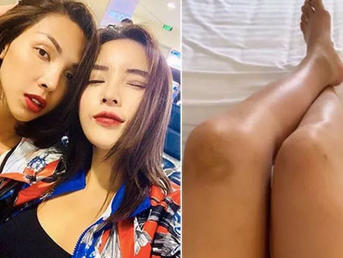 Hoa hậu Kỳ Duyên để lộ đôi chân bầm tím, nhiều vết thương