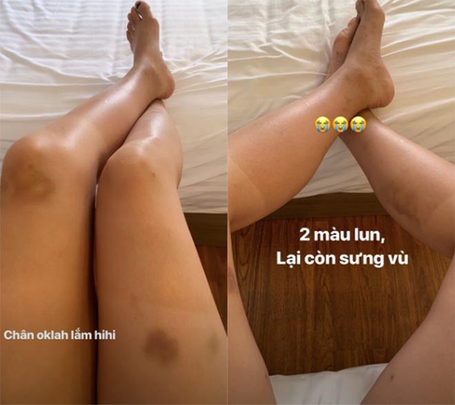 Hoa hậu Kỳ Duyên để lộ đôi chân bầm tím, nhiều vết thương-1