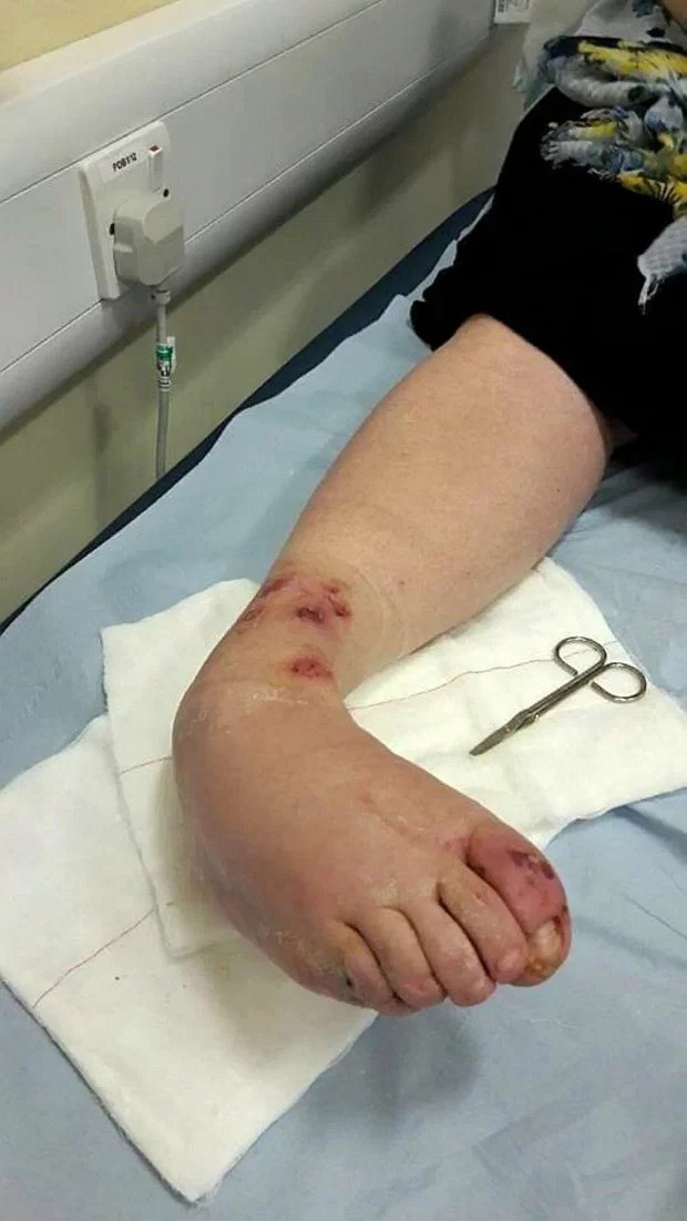 Bị lọ nước hoa rơi trúng chân, người phụ nữ chịu đựng nỗi đau suốt 2 năm trước khi buộc phải cắt bỏ một phần chân-2