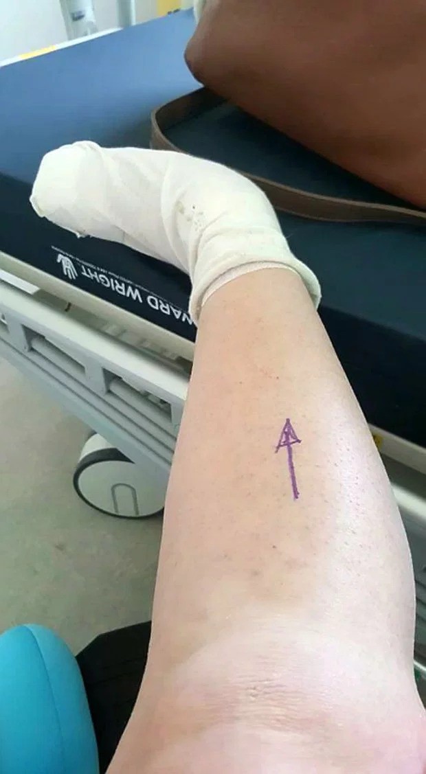 Bị lọ nước hoa rơi trúng chân, người phụ nữ chịu đựng nỗi đau suốt 2 năm trước khi buộc phải cắt bỏ một phần chân-3