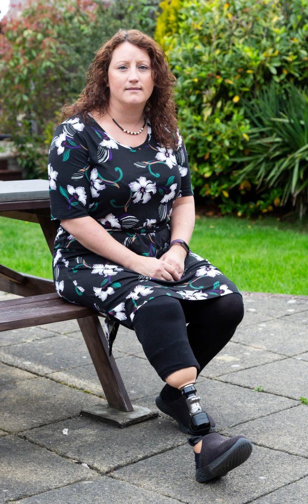 Bị lọ nước hoa rơi trúng chân, người phụ nữ chịu đựng nỗi đau suốt 2 năm trước khi buộc phải cắt bỏ một phần chân-4