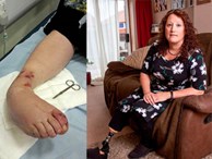 Bị lọ nước hoa rơi trúng chân, người phụ nữ chịu đựng nỗi đau suốt 2 năm trước khi buộc phải cắt bỏ một phần chân