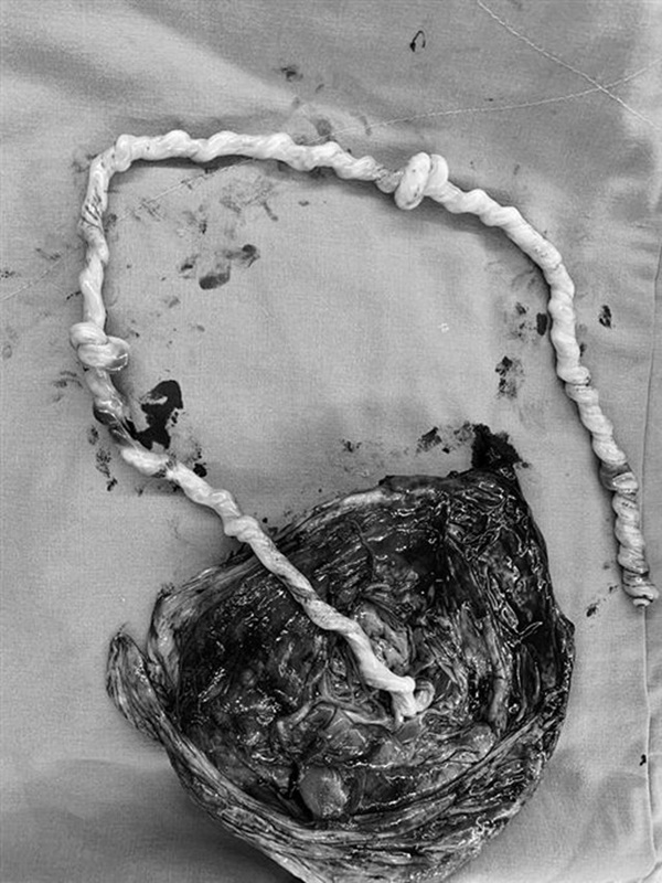 Sản phụ 35 tuần nhập viện cấp cứu, bác sĩ hoảng hốt vì chứng kiến điều chưa từng gặp suốt 20 năm qua-1