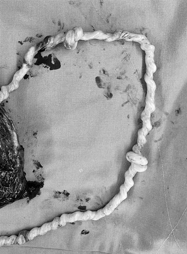 Sản phụ 35 tuần nhập viện cấp cứu, bác sĩ hoảng hốt vì chứng kiến điều chưa từng gặp suốt 20 năm qua-2