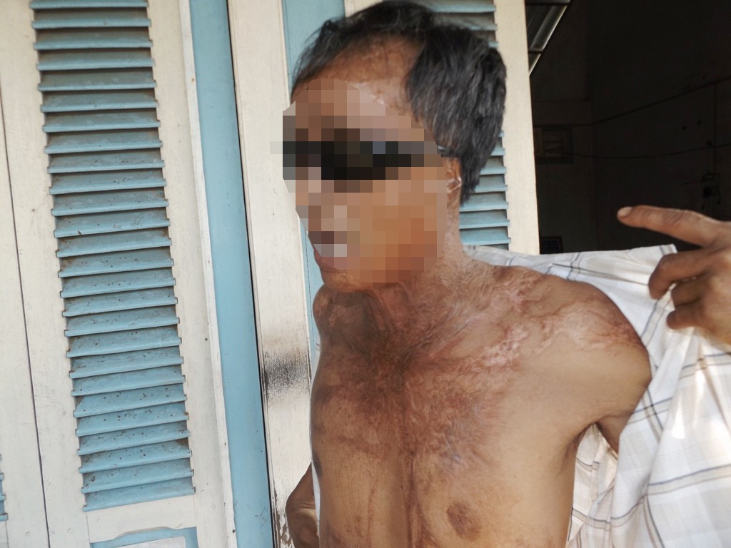 Nỗi ám ảnh kinh hoàng của những nạn nhân hứng đòn trả thù tàn độc bằng axit của kẻ cuồng ghen-1