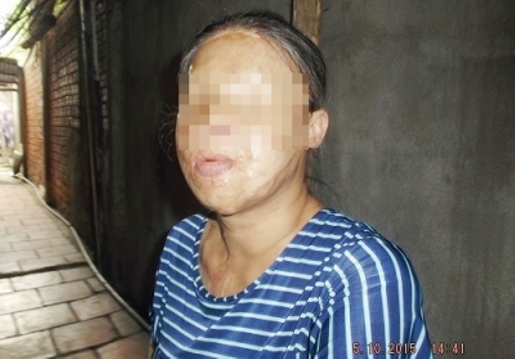 Nỗi ám ảnh kinh hoàng của những nạn nhân hứng đòn trả thù tàn độc bằng axit của kẻ cuồng ghen-2