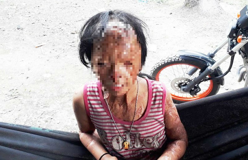 Nỗi ám ảnh kinh hoàng của những nạn nhân hứng đòn trả thù tàn độc bằng axit của kẻ cuồng ghen-3