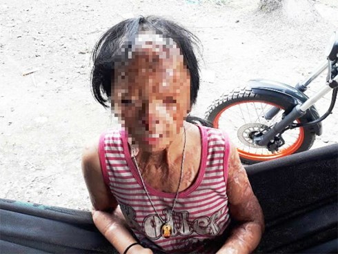 Nỗi ám ảnh kinh hoàng của những nạn nhân hứng đòn trả thù tàn độc bằng axit của kẻ cuồng ghen