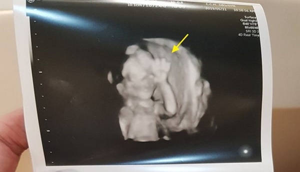 Chụp ảnh siêu âm mà giơ tay chào đủ kiểu, em bé từ trong bụng mẹ đã được dự đoán tương lai sau này vô cùng xán lạn-1