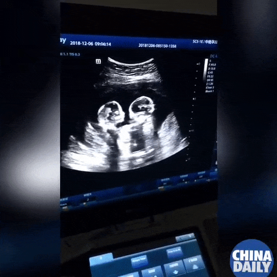 Chụp ảnh siêu âm mà giơ tay chào đủ kiểu, em bé từ trong bụng mẹ đã được dự đoán tương lai sau này vô cùng xán lạn-3