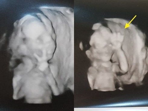 Hai tuần trước đi siêu âm vẫn bình thường, mẹ trẻ đau xót vì bỗng dưng con không đạp, mất tim thai khi đã 32 tuần-3