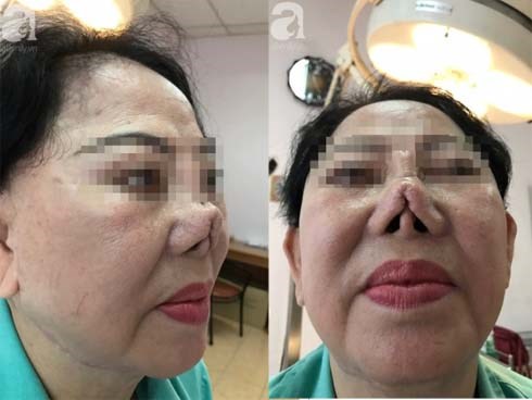Người phụ nữ 3 năm bị biến dạng mặt vì sửa mũi thất bại: