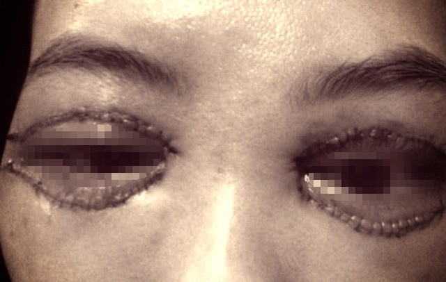 Cắt mí giúp mắt đẹp hơn nhưng làm không đúng bước này thì dễ rơi vào cảnh mắt xếch, mắt trợn ngược-2