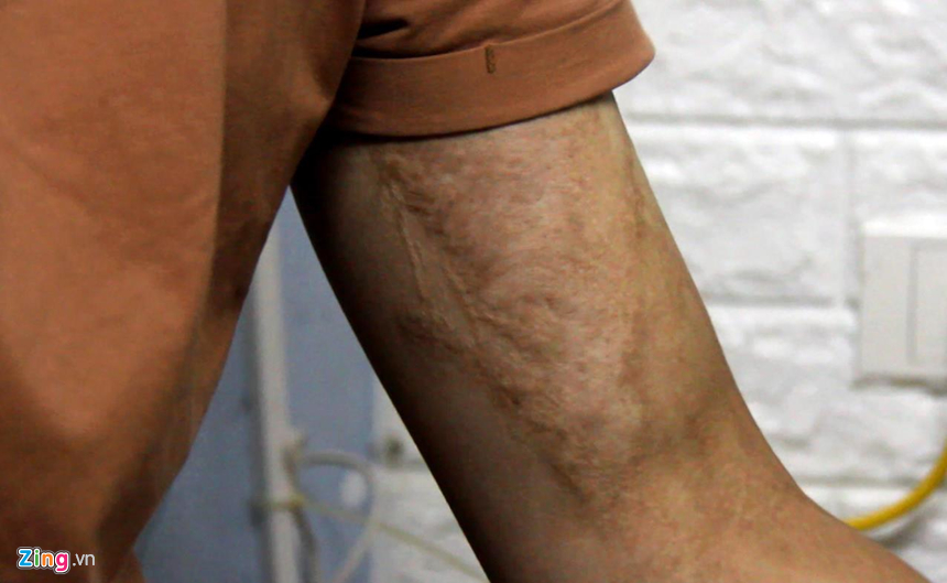 Ký ức buồn của nam sinh trường điện ảnh bị đánh ghen bằng axit-2