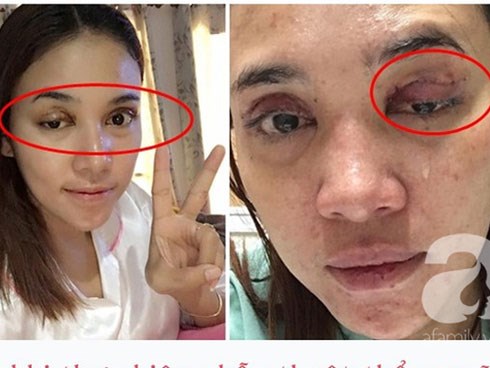 Cắt mí giúp mắt đẹp hơn nhưng làm không đúng bước này thì dễ rơi vào cảnh mắt xếch, mắt trợn ngược