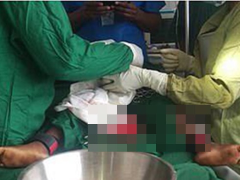 Tin bạn hơn tin bác sĩ khi chữa táo bón, người phụ nữ lĩnh” hậu quả là ruột đen xì, lốm đốm như da báo-4