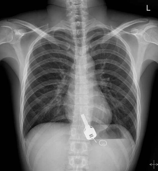 Tai nạn hy hữu: Người đàn ông say rượu bị mất chìa khóa xe, sáng hôm sau tỉnh dậy bất ngờ phát hiện ở một nơi không ai nghĩ đến-1