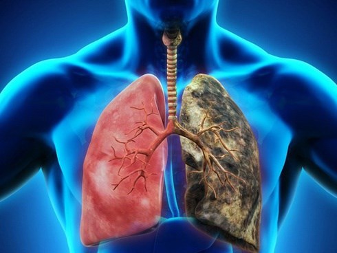 5 loại ung thư nguy hiểm có tính di truyền qua nhiều đời, đề phòng với những dấu hiệu