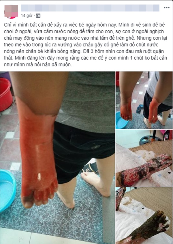 Chạy theo mẹ vào nhà vệ sinh, bé gái bị bỏng nước sôi cả 2 chân khiến ai nấy đều xót xa-1