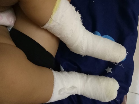 Buồn bực vô cớ, người phụ nữ nhúng chân cháu gái vào nước sôi cho hả giận, khiến cô bé bị bỏng nặng có nguy cơ phải cắt chân-5