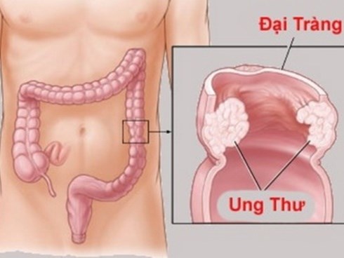 Món ăn triệu người mê khiến người đàn ông 30 tuổi mắc ung thư đại trực tràng giai đoạn cuối