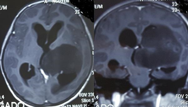 Con bị u não, mẹ đưa về ăn rau 2 tháng để triệt khối u và cái kết bất ngờ-1