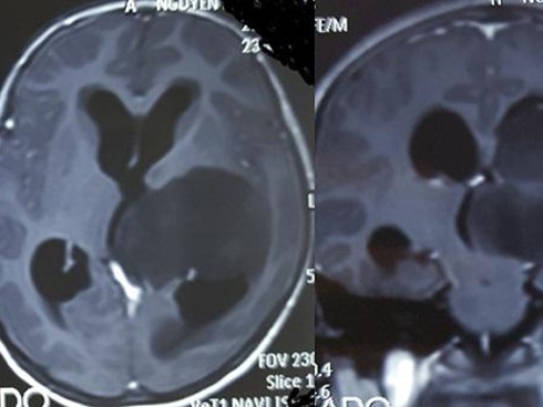 Từ vụ bé gái ở Vĩnh Phúc nguy kịch vì bố mẹ chữa u não bằng Keto, bạn cần phải hiểu thật rõ về chế độ ăn này-4