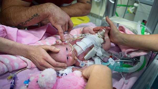 Bé gái mắc hội chứng tim ngoài lồng ngực chỉ có 10% sống sót, bố mẹ em quyết định làm việc này và điều kì diệu xảy ra-2