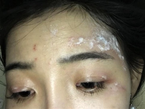 Kiến ba khoang tấn công, độc tố mạnh gấp 12-15 lần rắn hổ mang: Đây là cách xử lý ĐÚNG NHẤT bác sĩ khuyên làm-4