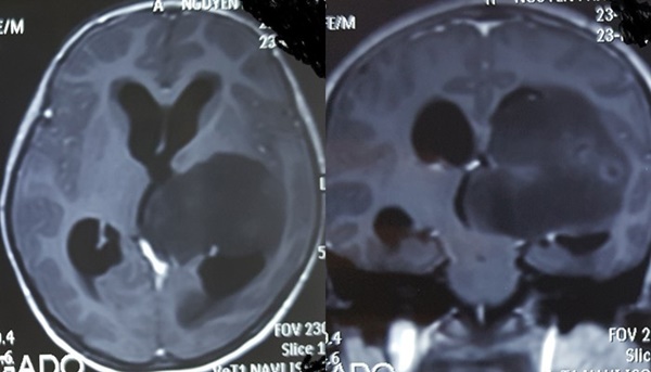 Từ vụ bé gái ở Vĩnh Phúc nguy kịch vì bố mẹ chữa u não bằng Keto, bạn cần phải hiểu thật rõ về chế độ ăn này-1