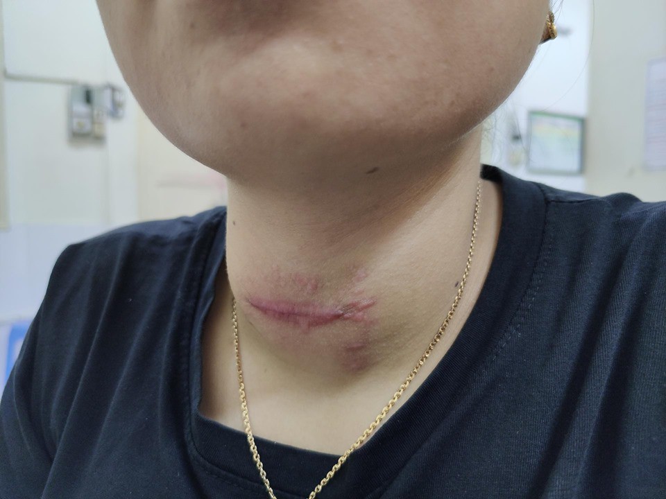 Tự chữa bệnh về tuyến giáp bằng phương pháp thầy lang, cô gái Hải Phòng bị nhiễm trùng nghiêm trọng vùng cổ-2