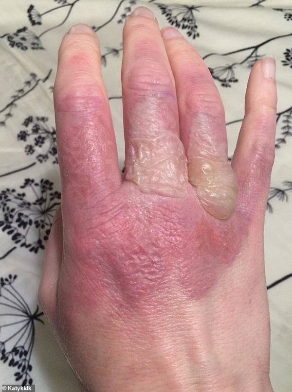 Sau khi vắt nước chanh, người phụ nữ vô tình làm điều này khiến da phồng rộp-1